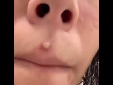 Pimple Popping Videos Blackhead Removal 3