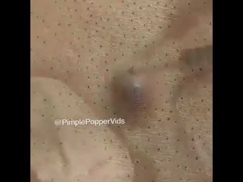 Pimple popping [Viwers Discretion]