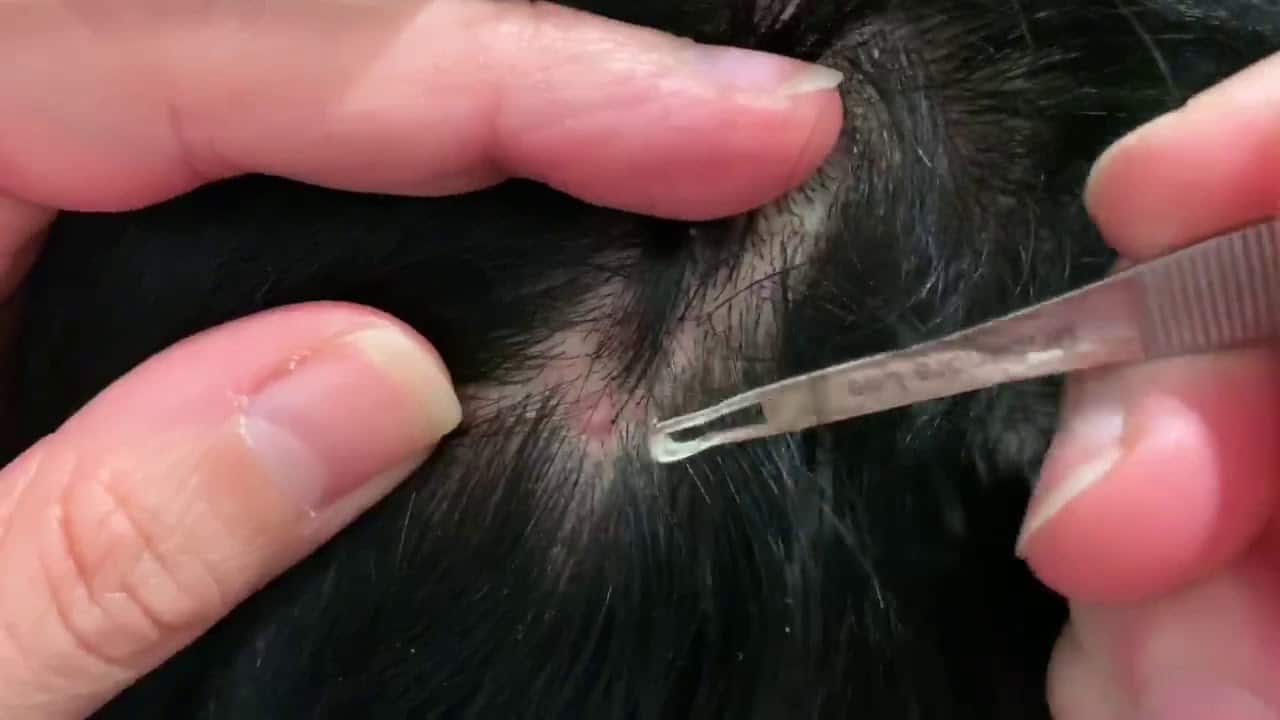 Pimple popping (VOLUME UP!!)