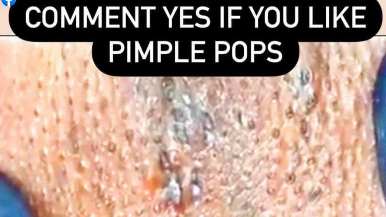Pimple Popping Week in Review #69