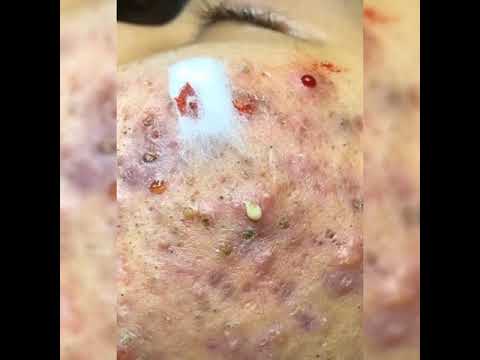 Pimple Popping Whiteheads….Its look gross….. but satisfy