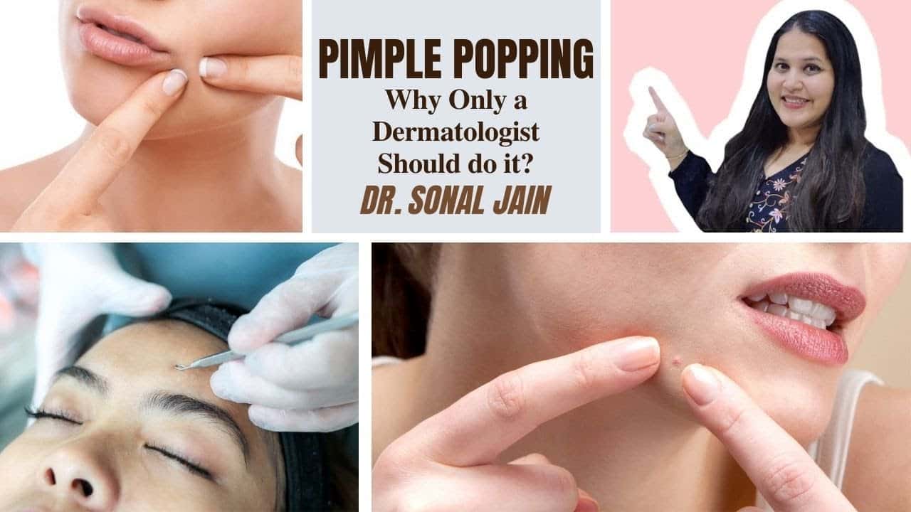Pimple Popping | Why Only a Dermatologist Should do it? | Skinsquare by Dr Sonal Jain