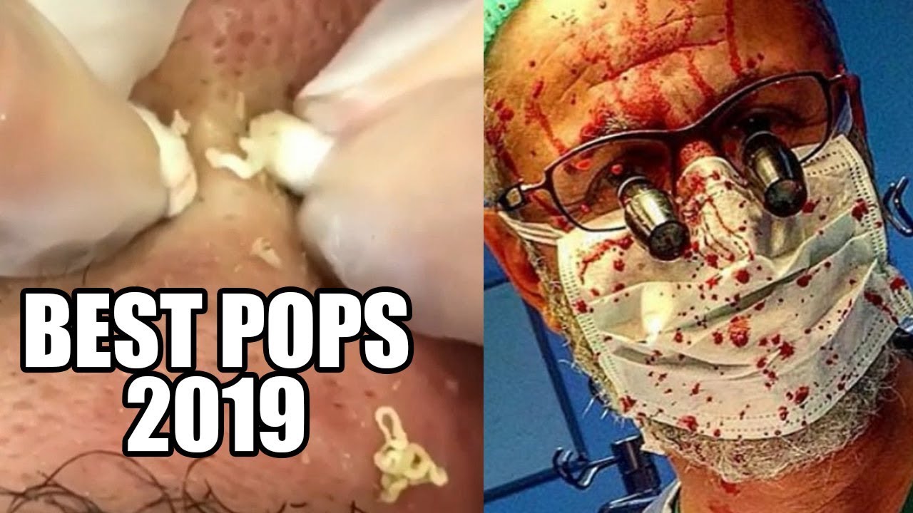 Pimple Popping Year in Review!  Comedone Extractors, Cysts & Surgery!