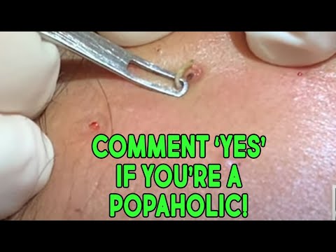 Pimple Popping! You Love It?  I Love It Myself!