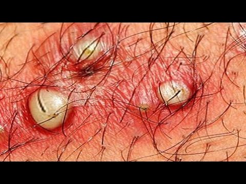 Pimple Popping & Zit Bursting or Snakes & Spiders Bites