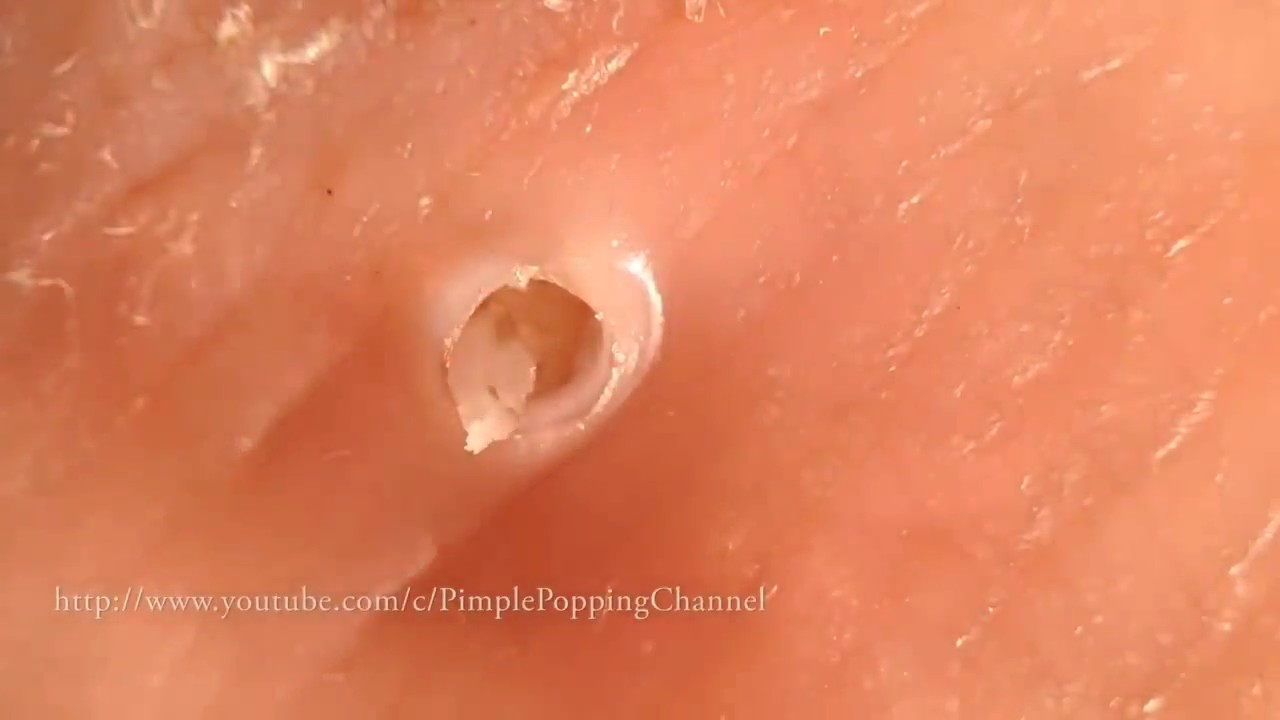 Pimple popping…white puss!