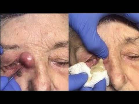 PIMPLE REMOVAL #18 (Satisfying) – NEW Pimple Popping 2020