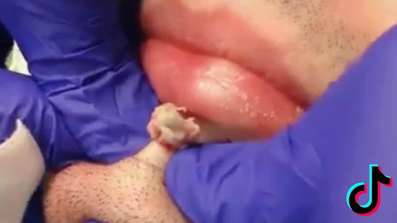 PIMPLES CYSTS AND BLACKHEADS Compilation #1