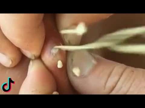 PIMPLES CYSTS AND BLACKHEADS Compilation #2