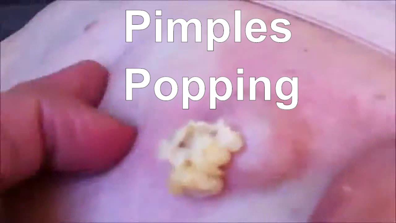 Pimples Popping 2017
