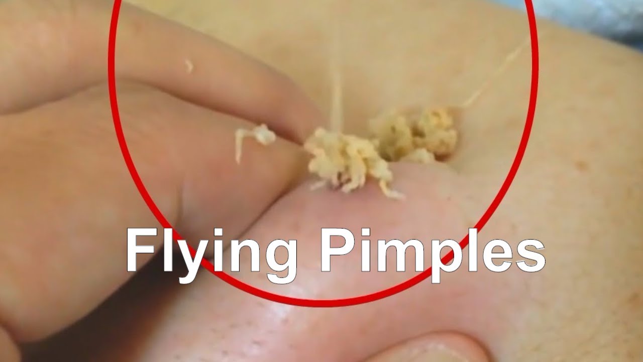 Pimples Popping:Flying Pimples, Try not to look away if you can