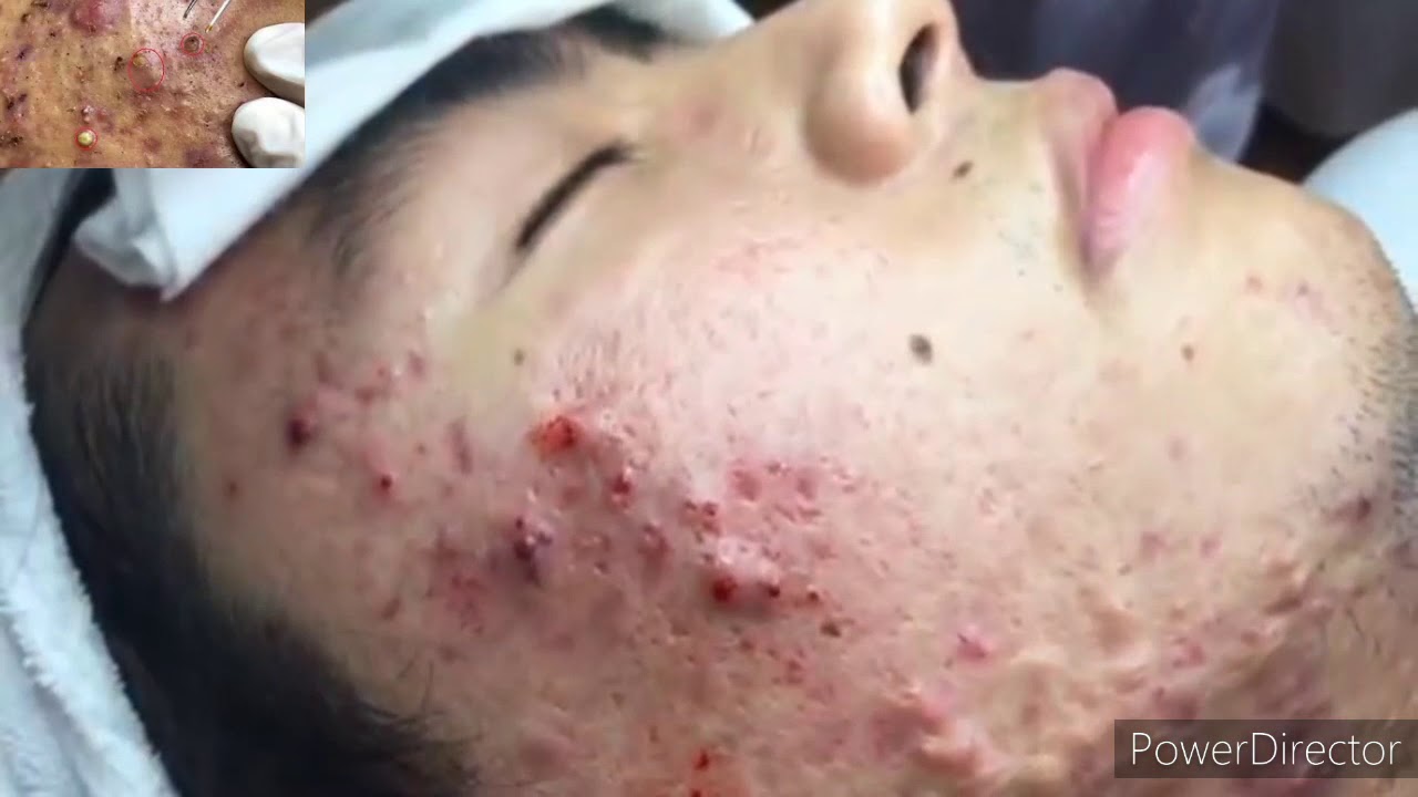 pimples removal on face | Larges pimple blackheads and WhiteHead son