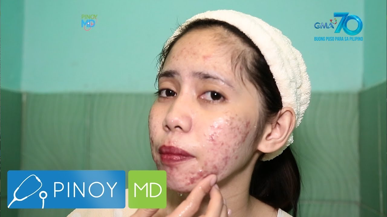 Pinoy MD: Pimple myths: Mga epektibo at 'di epektibong paraan para mawala ang pimples