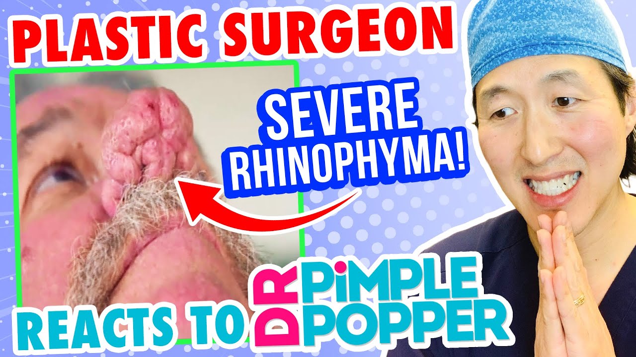 Plastic Surgeon Reacts to DR. PIMPLE POPPER! Massive Growth on NOSE! – Dr. Anthony Youn