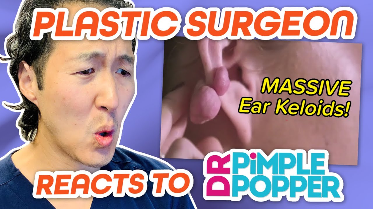 Plastic Surgeon Reacts to DR. PIMPLE POPPER! Massive Keloids on the Ears – Dr. Anthony Youn