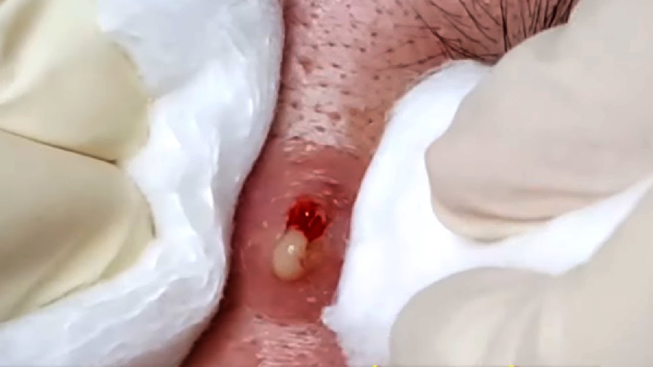 Pmple Popping on face|Cystic extraction on face
