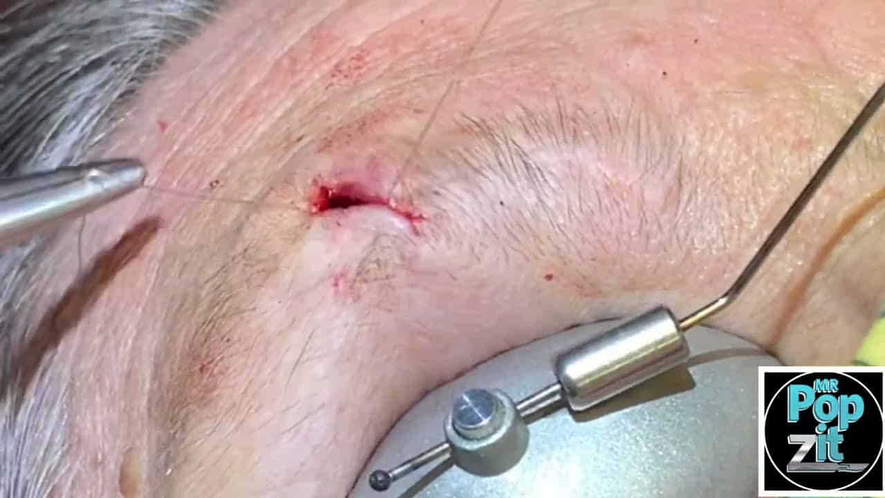 Pocket full of Pebbles cyst. One of a kind pebble pop! You’ve never seen a pebble cyst pop before.