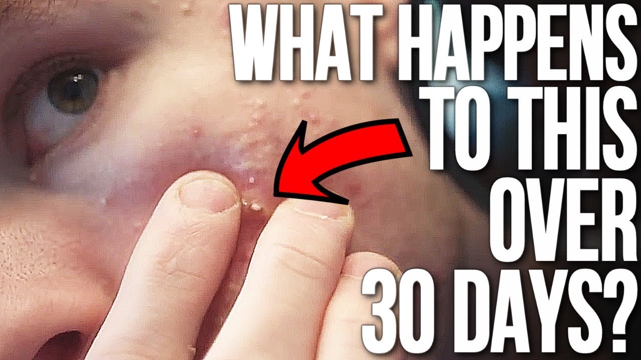 Pop A Big Zit or Cyst & See What Happens! (MONTH TIMELINE)