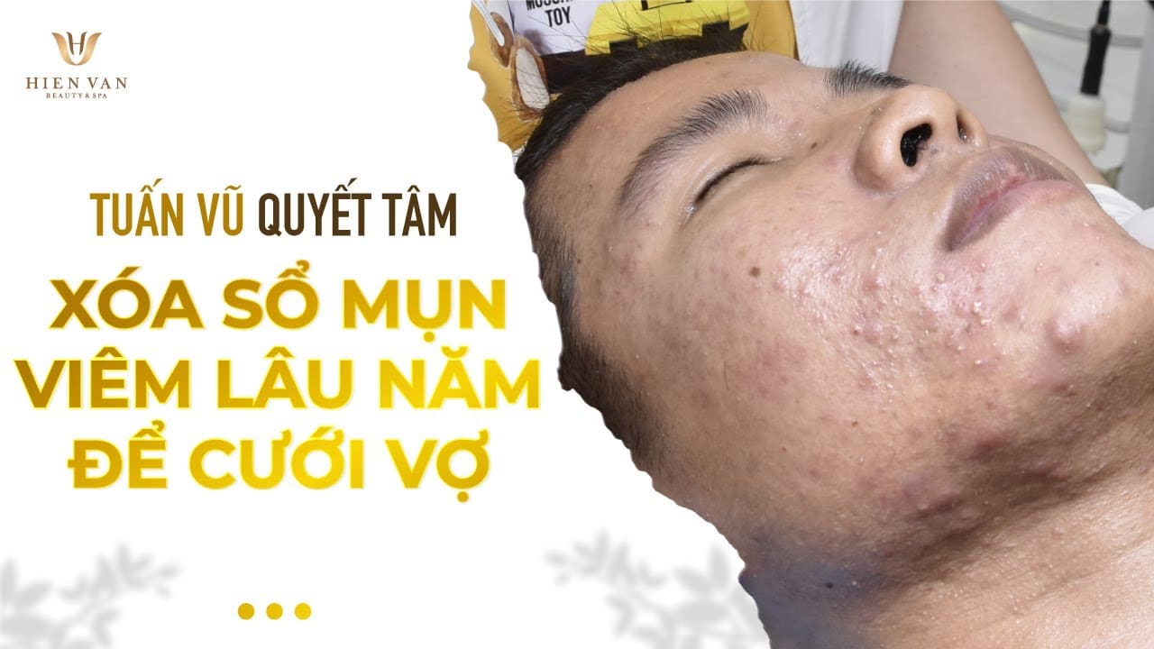 Pop cyst,blackheads drastically at hien van spa-Mai Tuấn Vũ-421