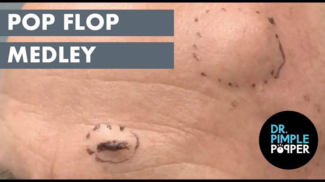 Pop Flop Medley! Steatocystoma and Blackheads