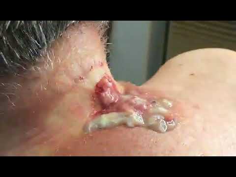 pop pimple – Pimple Popping Lovers