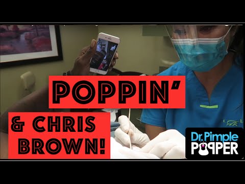 Poppin’ a Difficult Cyst on the Scalp & FaceTiming with Chris Brown!