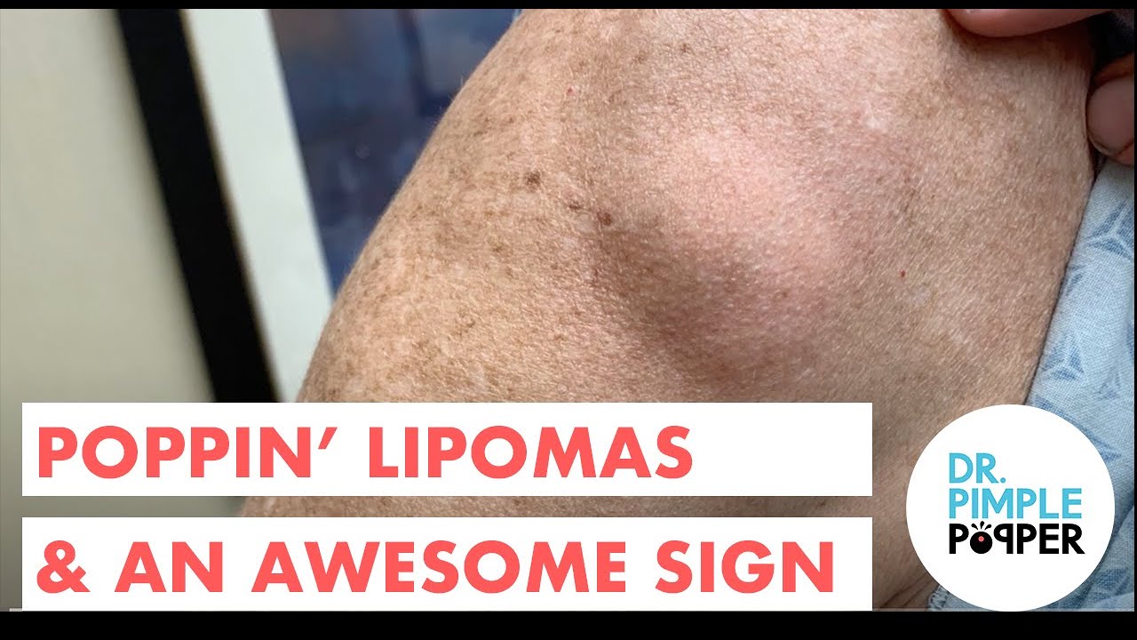 Poppin’ Lipoma & An Awesome Neon Sign