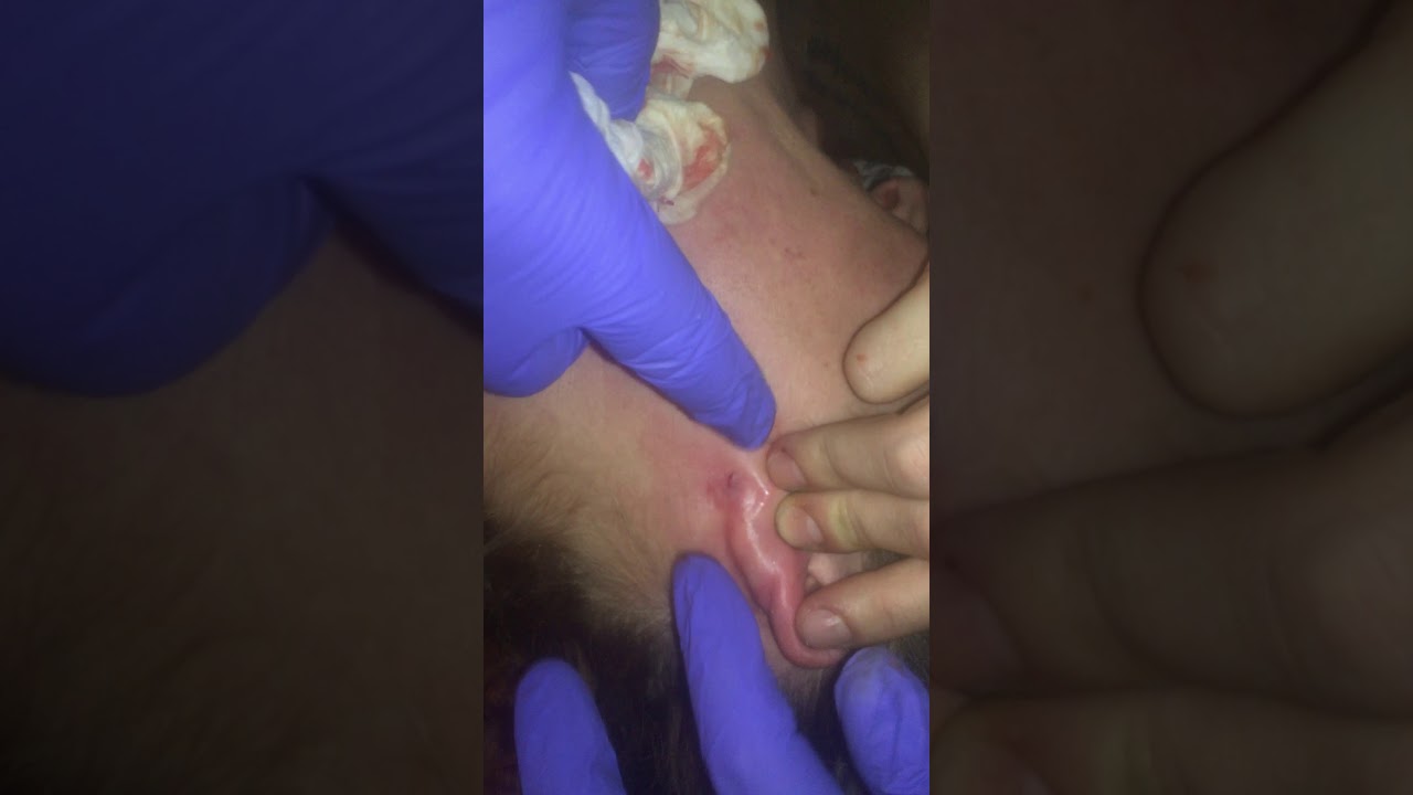 Popping a cyst