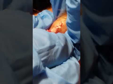 Popping a cyst