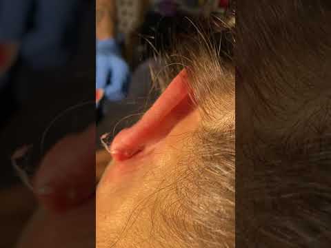 Popping a cyst in Maddy’s ear