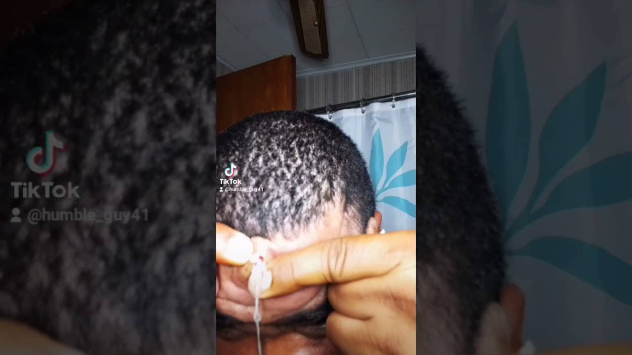 popping a cyst