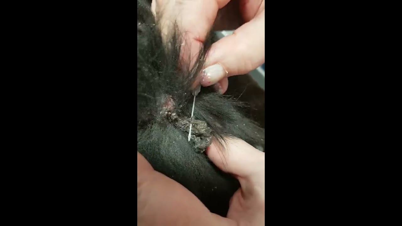 Popping a HUGE old Cyst