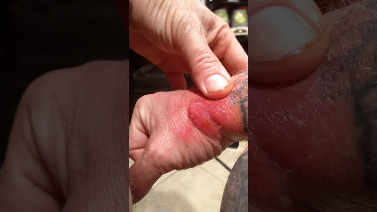 Popping a spider bite/cyst on my hand