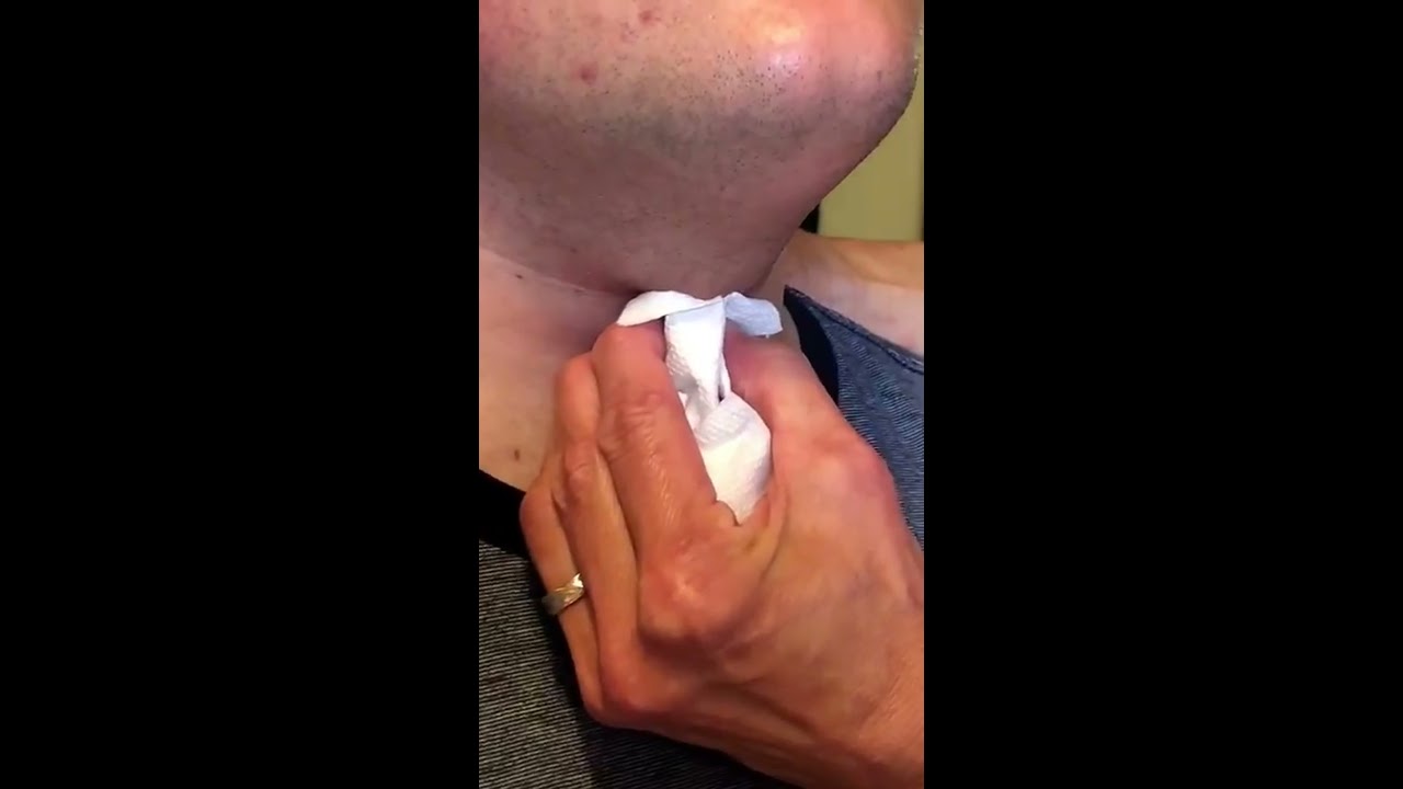 Popping a Thyroglossal duct cyst