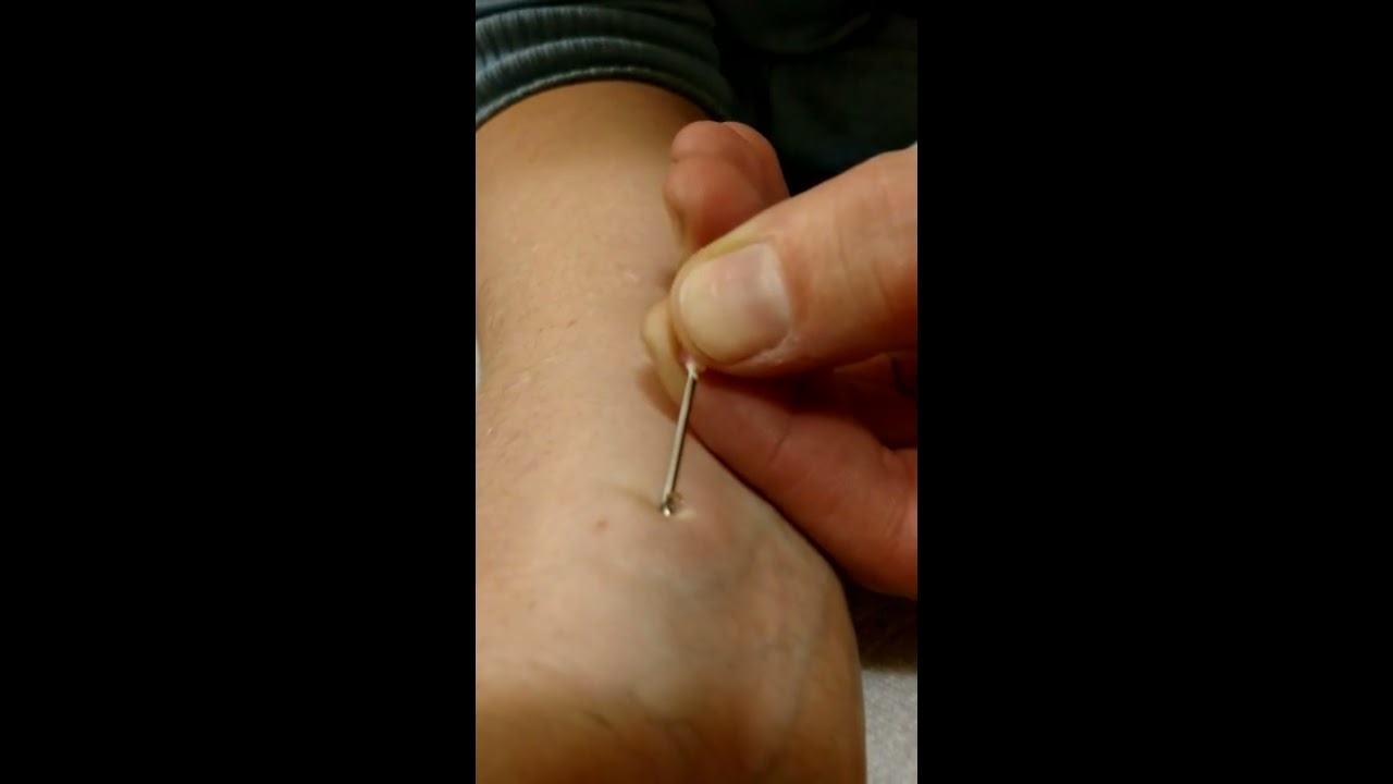 Popping a tiny ganglion cyst on my wrist!