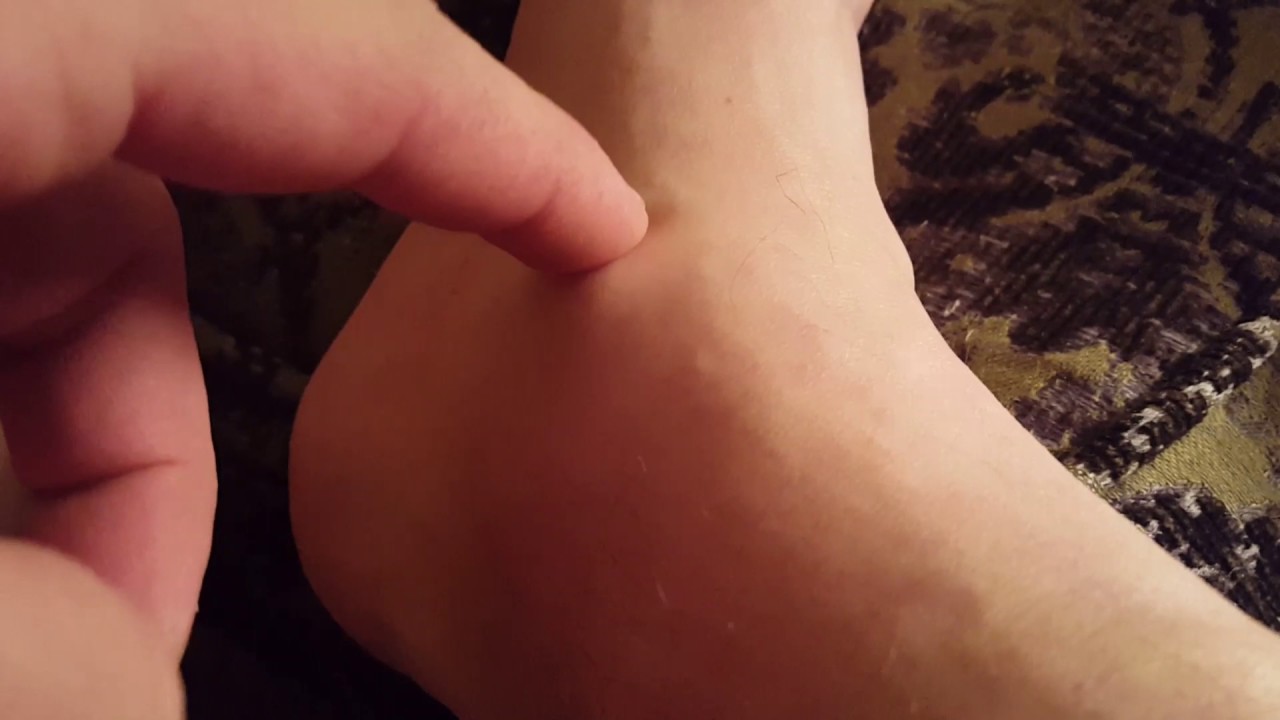 Popping an ankle cyst with a bible! No joke!