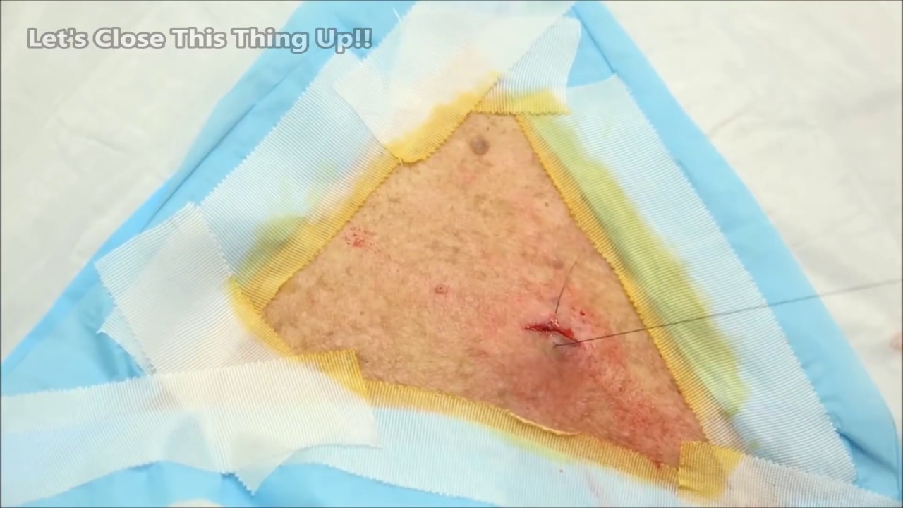 Popping Back Zit?  Epidermoid Cyst Removal