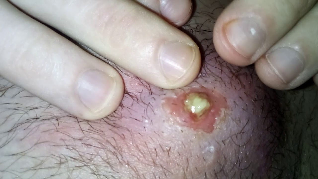 Popping big pimple!