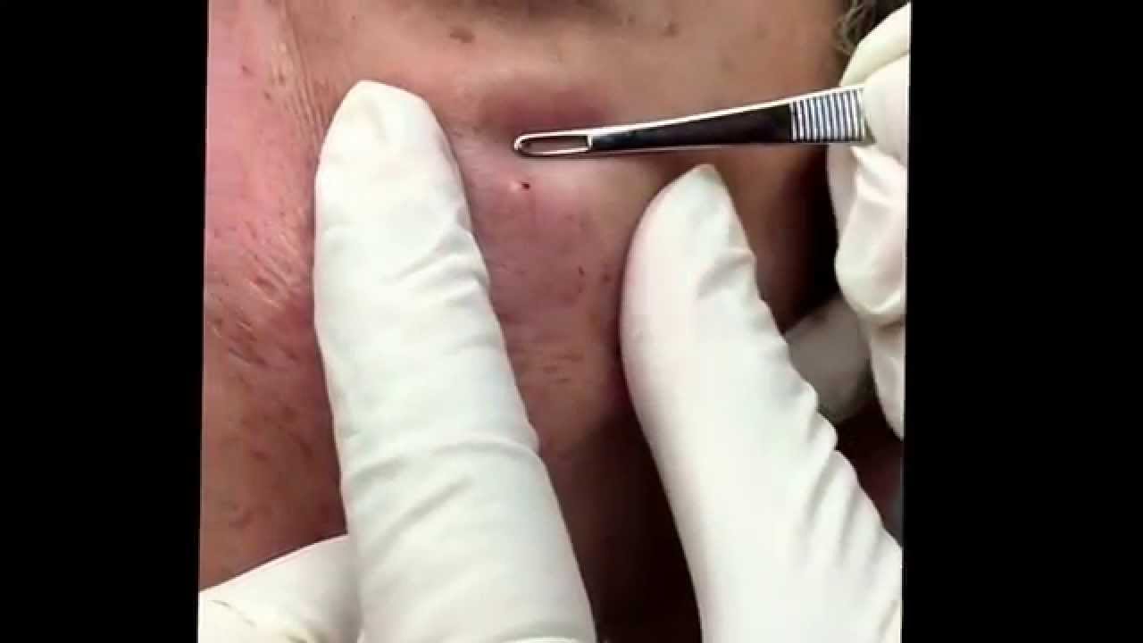 Popping blackheads and extracting milia. For medical education- NSFE.
