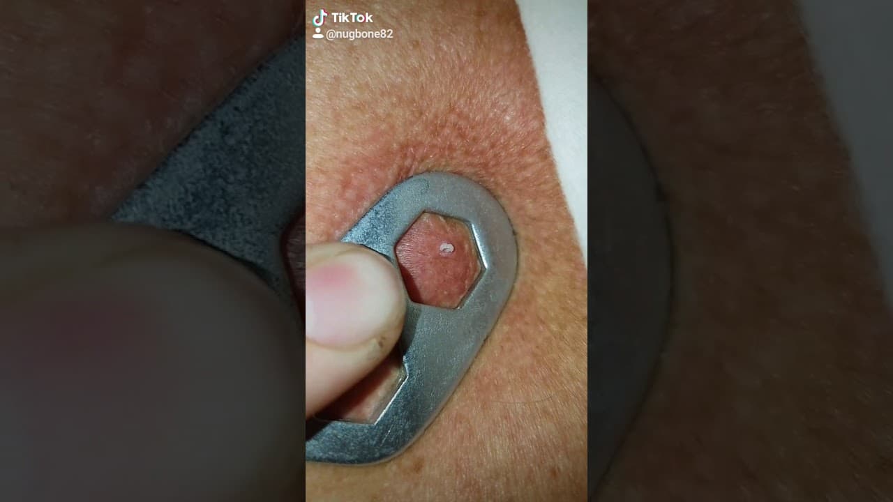 Popping cyst on back