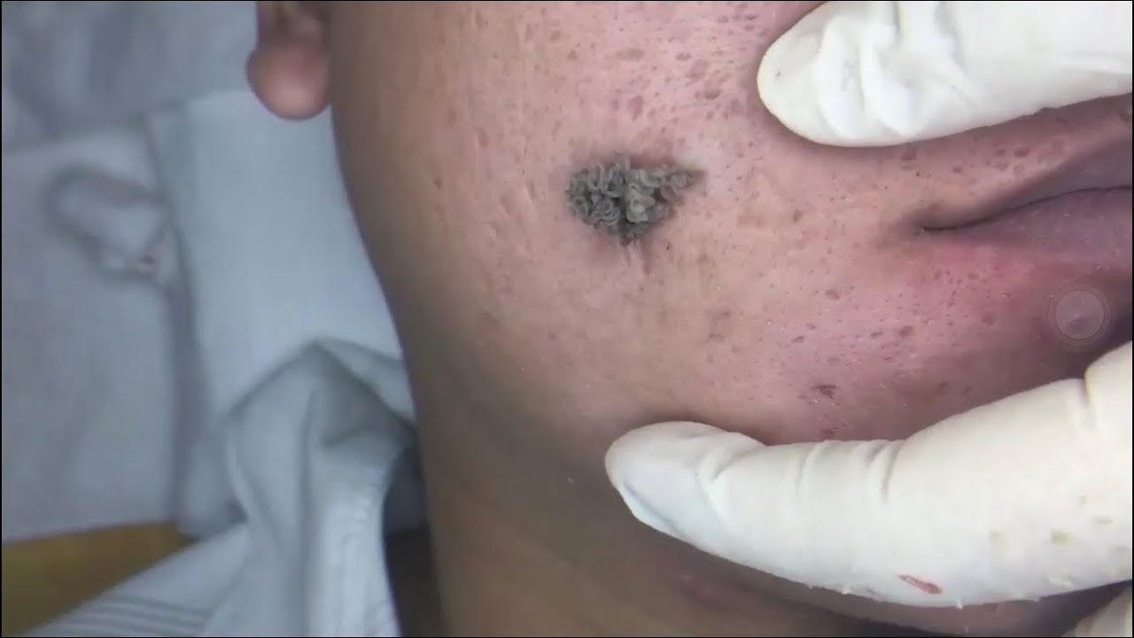 Popping Cyst on Face