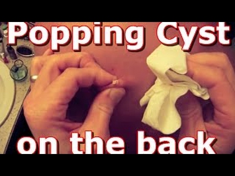 Popping Cyst on the back AAHC