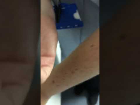 Popping cyst