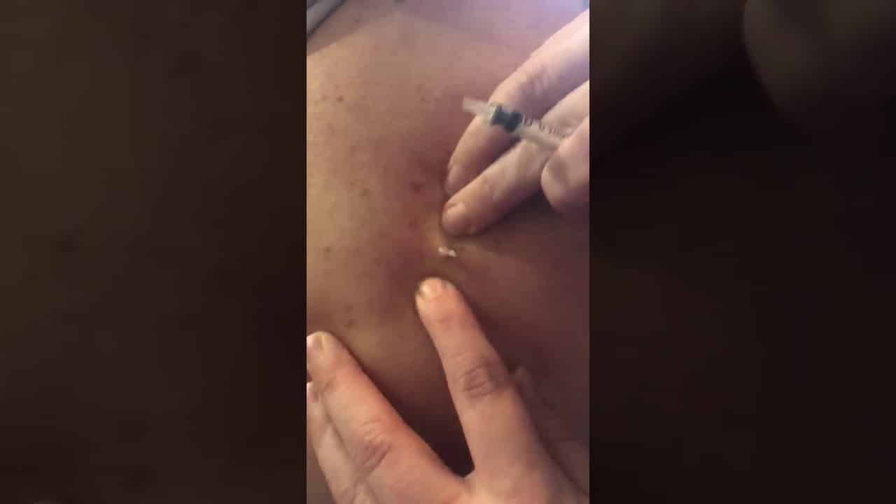 Popping cystic pimple on back ?