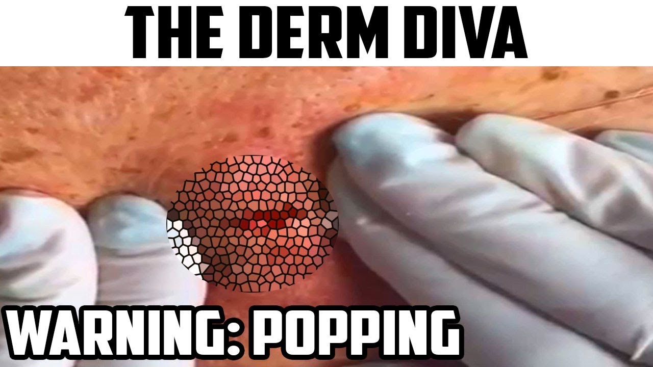 Popping Cysts, Blackheads & Pimples with The Derm Diva
