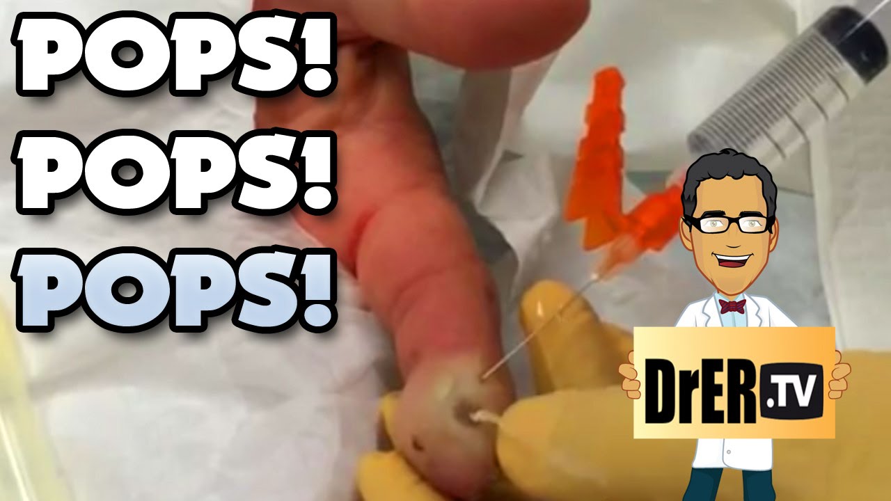 Popping Finger Felon!  Zits, Pimples, Abscesses and Cysts