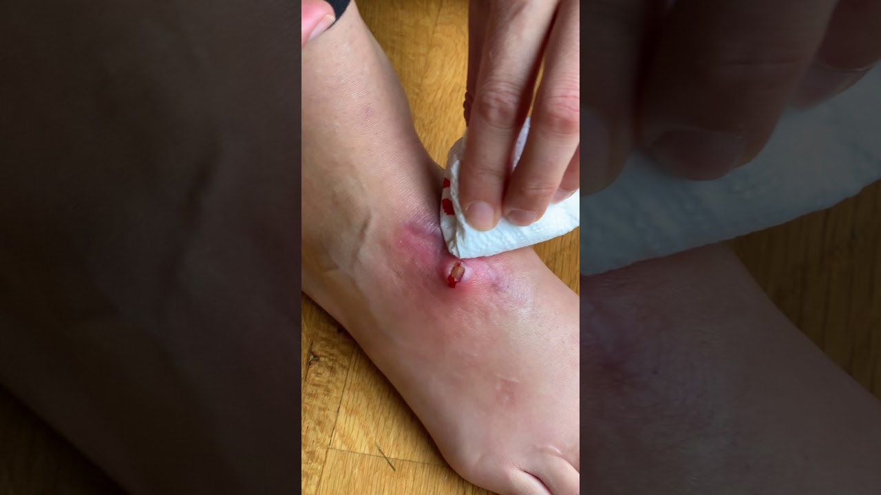 Popping Ganglion Cyst (part 1)