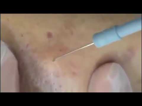 popping giant cyst