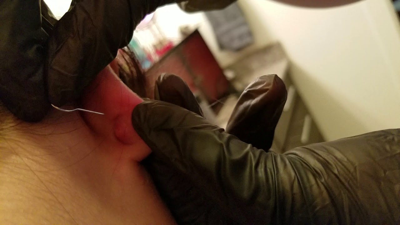 Popping giant ear cyst!!!!