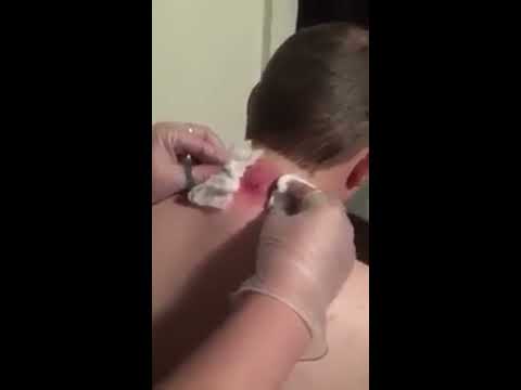 Popping giant pimple on back of neck painful, New video 2017